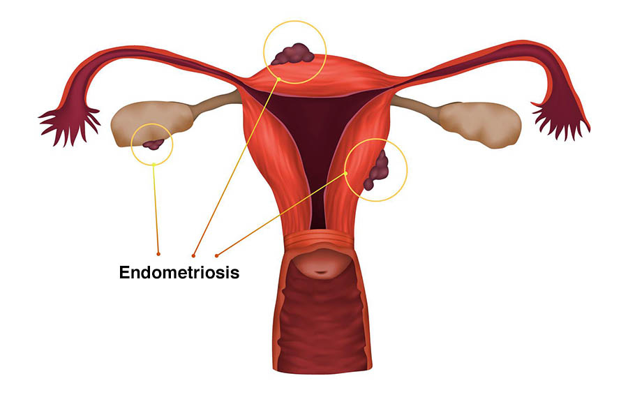 Endometrióza